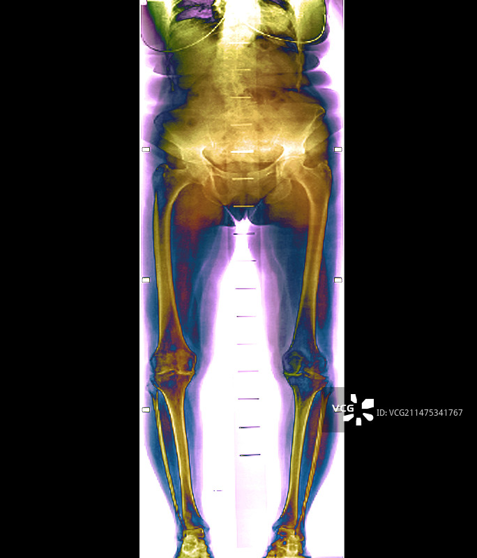 双侧膝关节骨关节炎X光片图片素材
