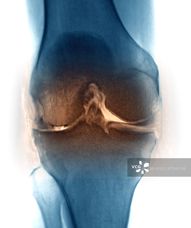 膝关节骨关节炎X光和MRI扫描图片素材