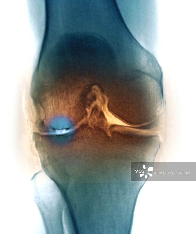 膝关节骨关节炎X光和MRI扫描图片素材