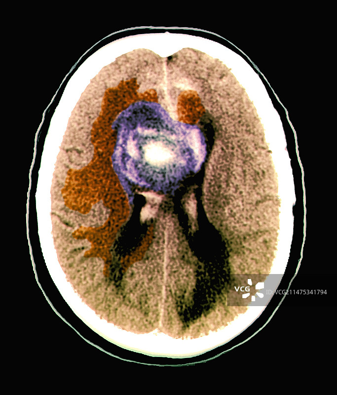 脑部胶质母细胞瘤CT扫描图片素材