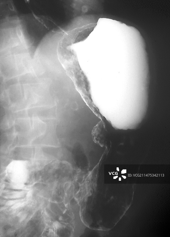 胃淋巴瘤胃癌X光片图片素材