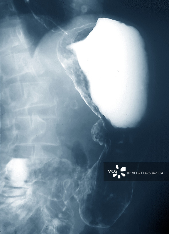 胃淋巴瘤胃癌X光片图片素材