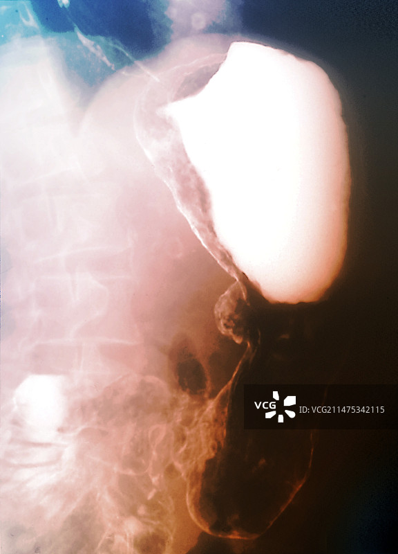 胃淋巴瘤胃癌X光片图片素材