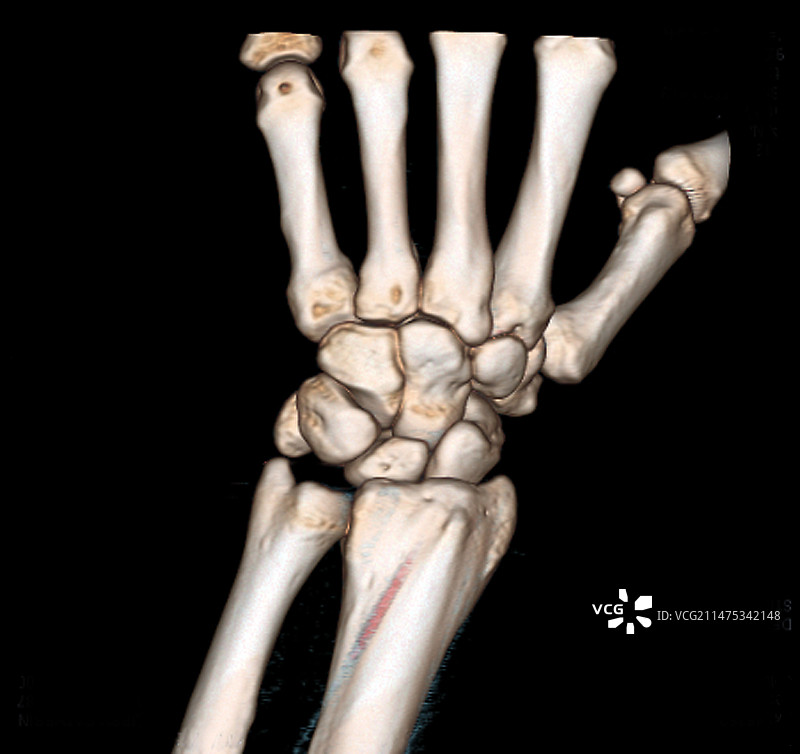 正常手腕3D CT扫描图片素材