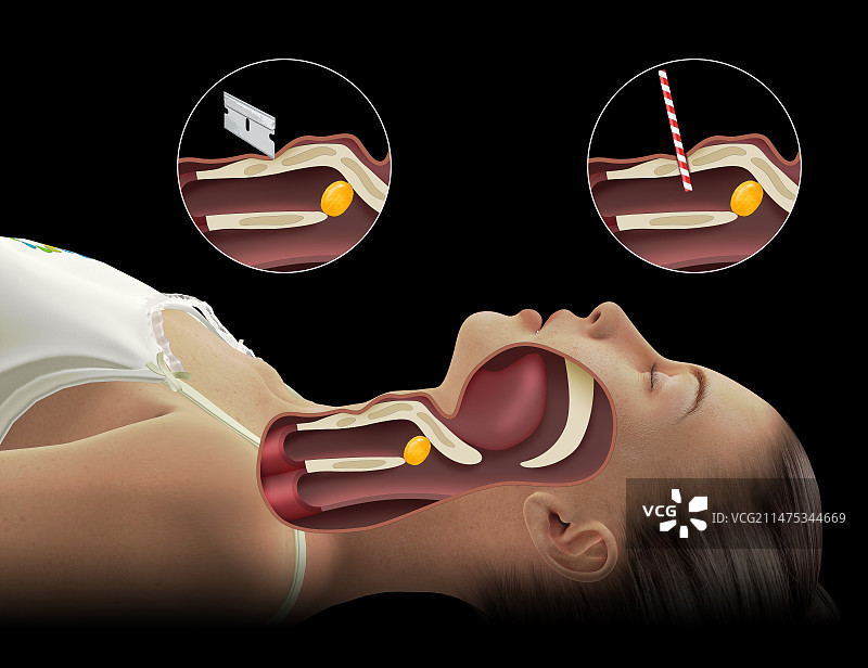 紧急气管切开术插图图片素材