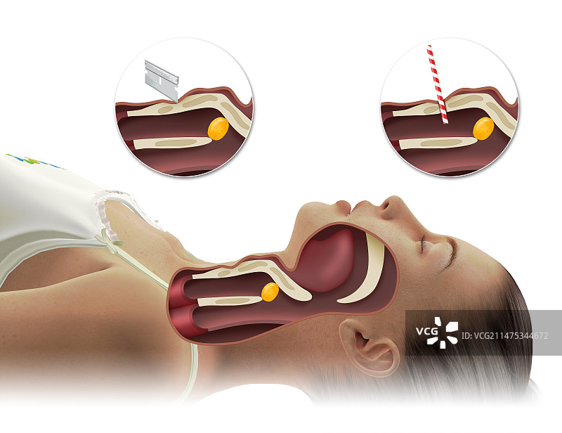 紧急气管切开术插图图片素材