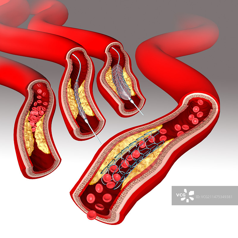 带支架血管成形术插图图片素材