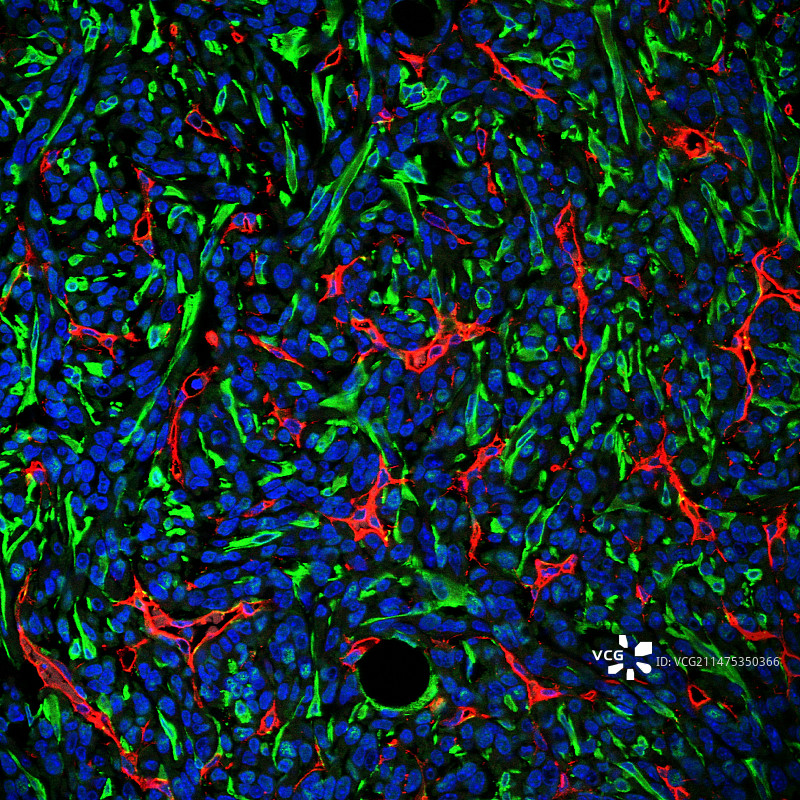 乳腺癌肿瘤组织 Confocal显微照片图片素材