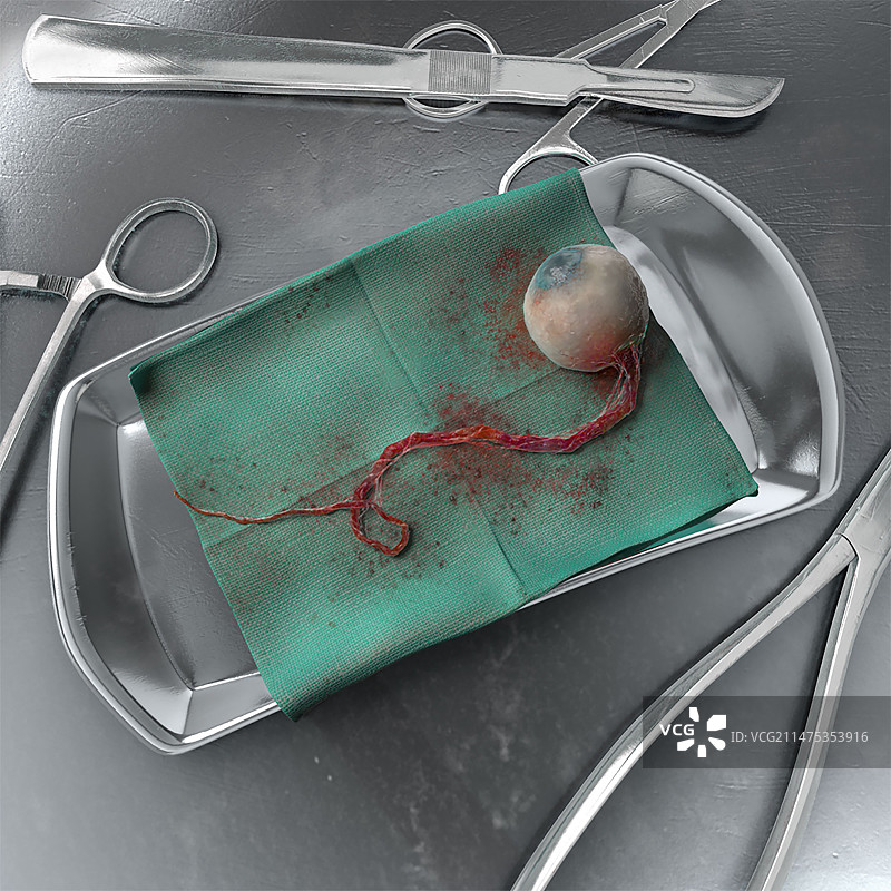 眼部病理检查插图图片素材