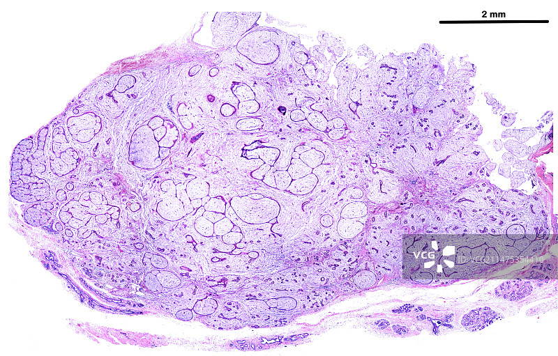 乳腺纤维腺瘤显微照片图片素材