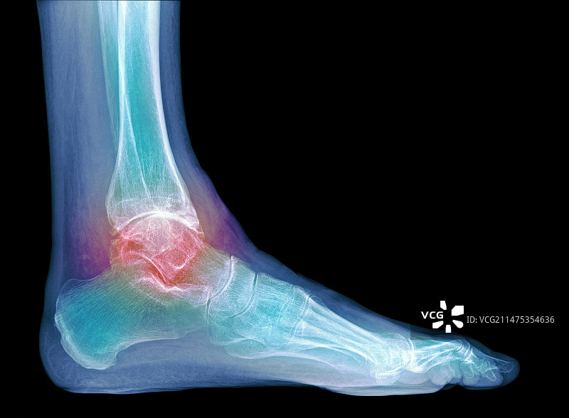 踝关节骨关节炎X光片图片素材