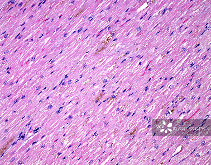 遗传性血色病浅显显微照片图片素材