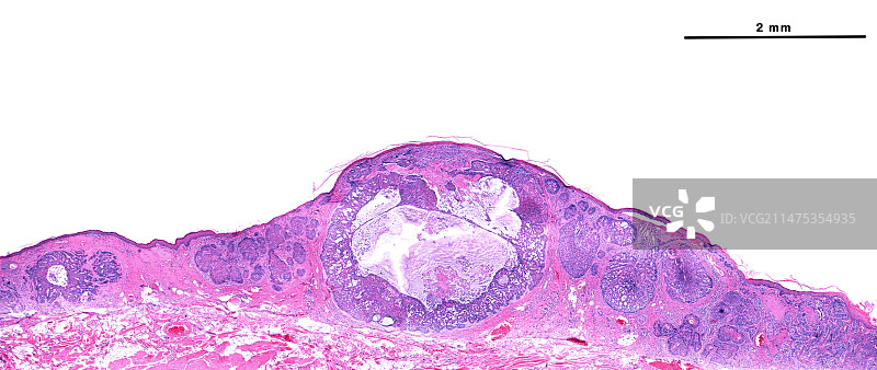 基底细胞癌浅显显微照片图片素材