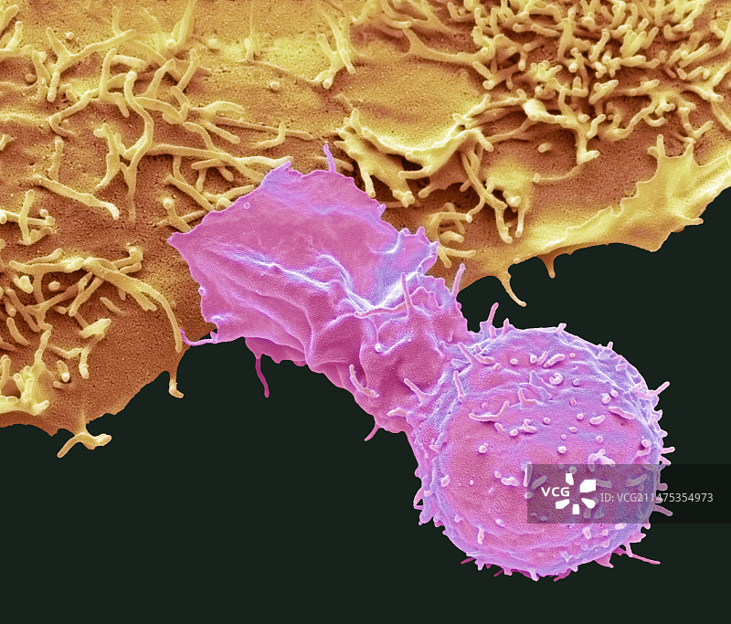 自然杀伤细胞和癌细胞，扫描电镜图片素材