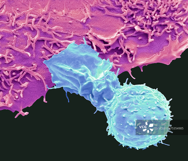 自然杀伤细胞和癌细胞，扫描电镜图片素材