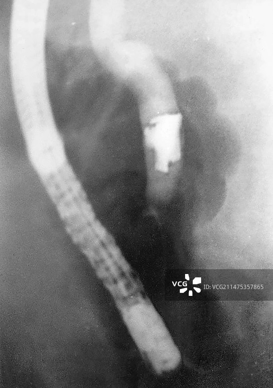 X光片显示：胆道梗阻的手榴弹碎片图片素材