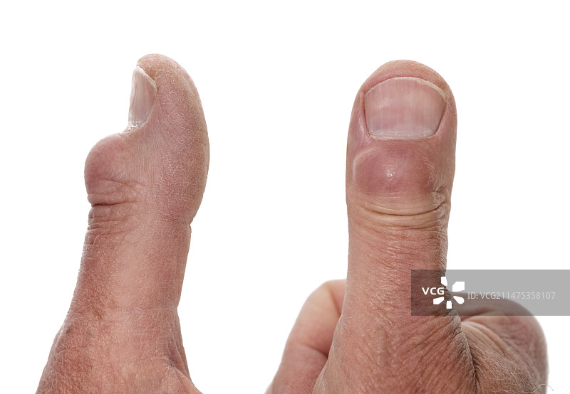 拇指上的巨大粘液囊肿图片素材