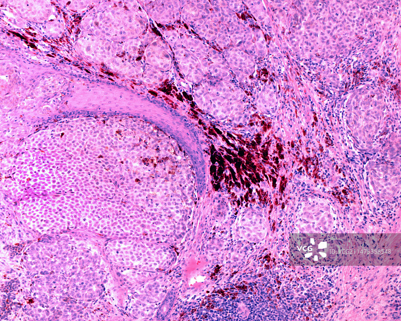 神经上皮瘤，光学显微照片图片素材