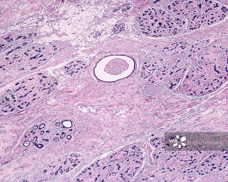纤维囊性乳腺改变光学显微照片图片素材