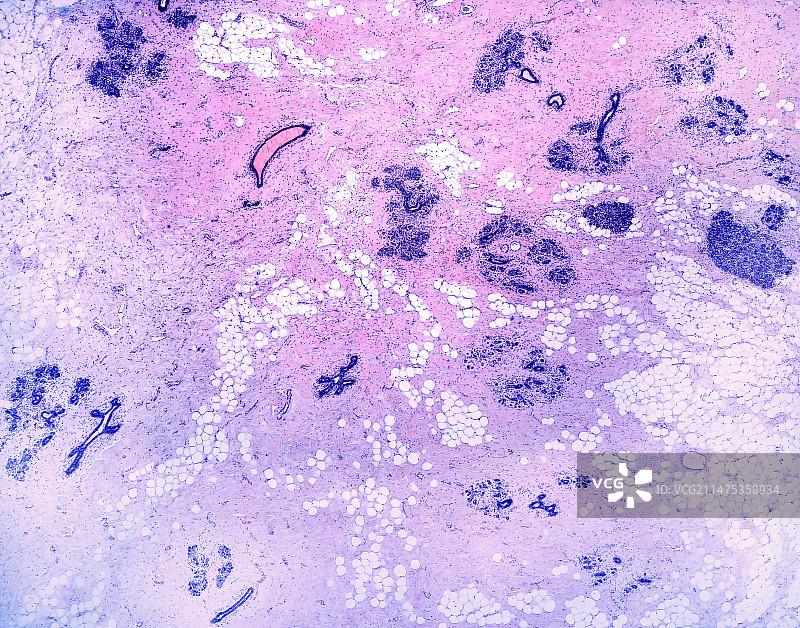 硬化性腺病显微照片图片素材