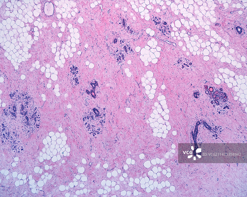 乳腺纤维化显微照片图片素材