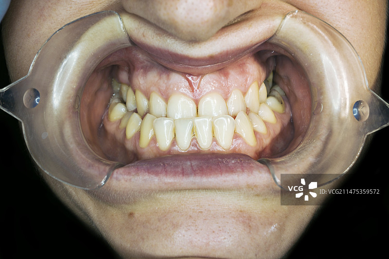 地包天图片素材