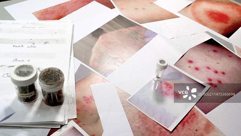 叮咬和刺痛诊断图片素材