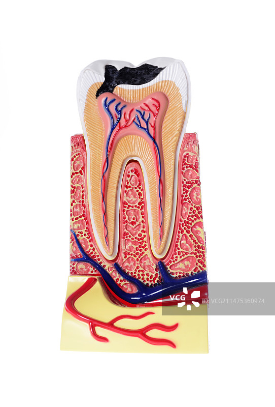 龋齿模型图片素材