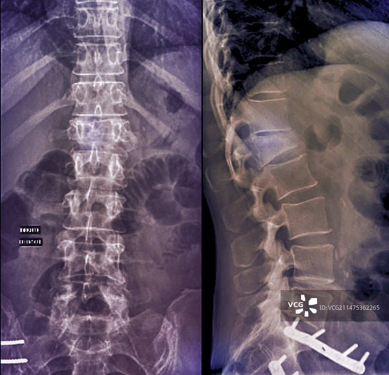 腰椎压缩性骨折X光片图片素材