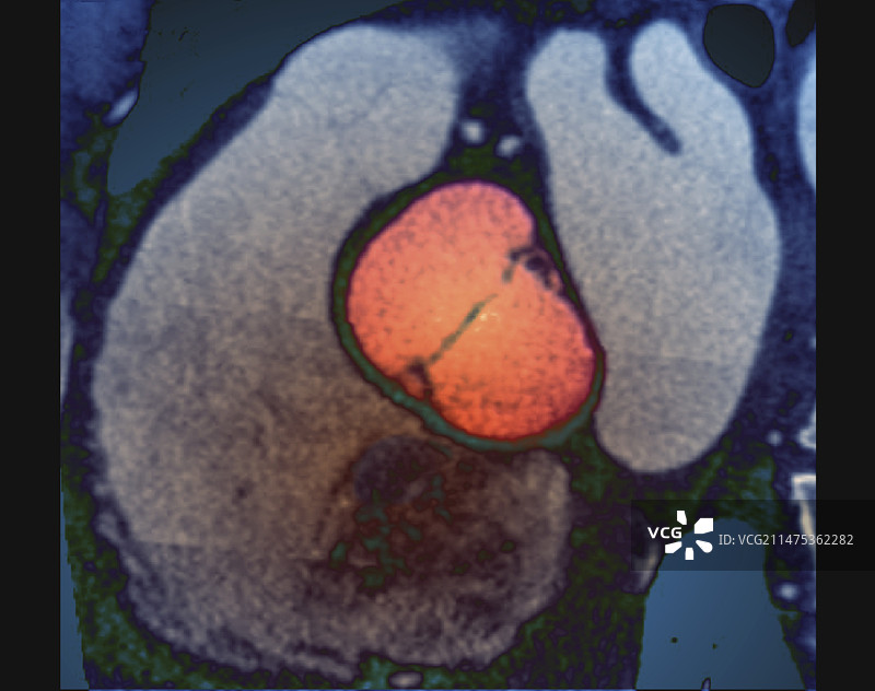 先天性主动脉瓣畸形CT扫描图片素材