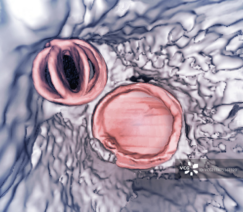 心脏瓣膜置换，3D CT扫描图片素材
