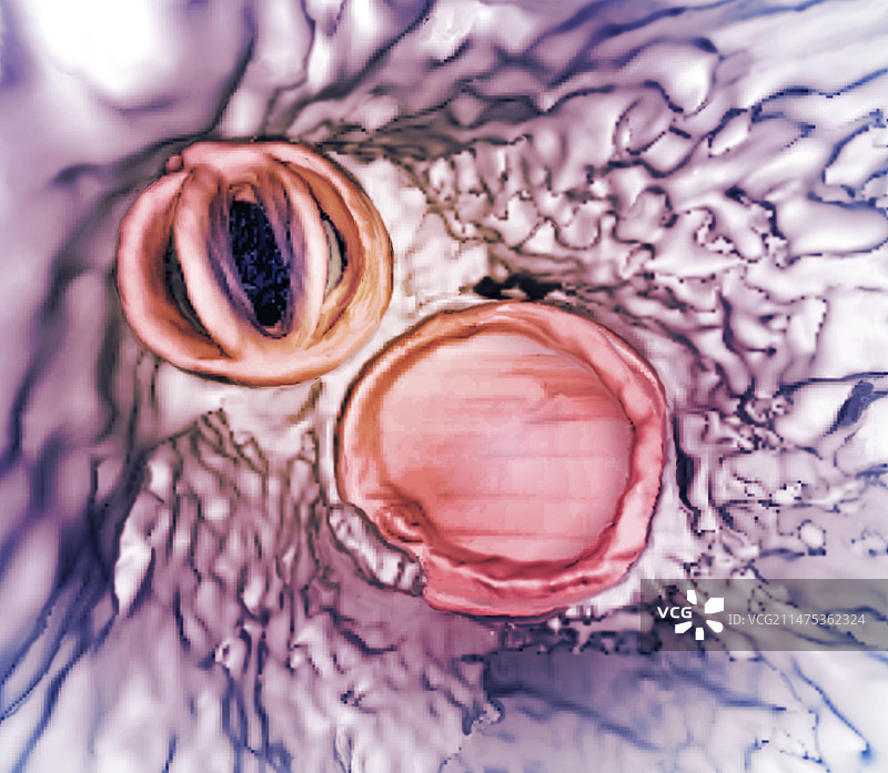 心脏瓣膜置换，3D CT扫描图片素材