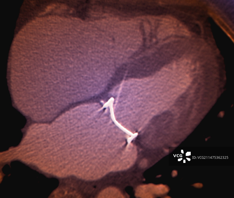 二尖瓣置换术CT扫描图片素材