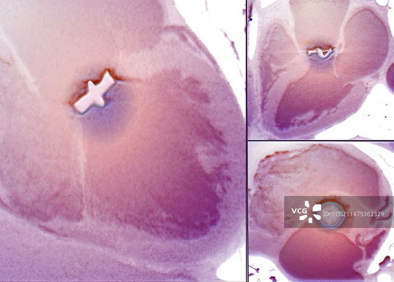 主动脉瓣置换术CT扫描图片素材