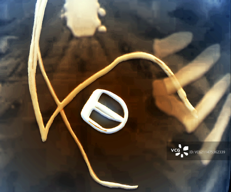 主动脉瓣膜假体和起搏器导线，CT扫描图片素材