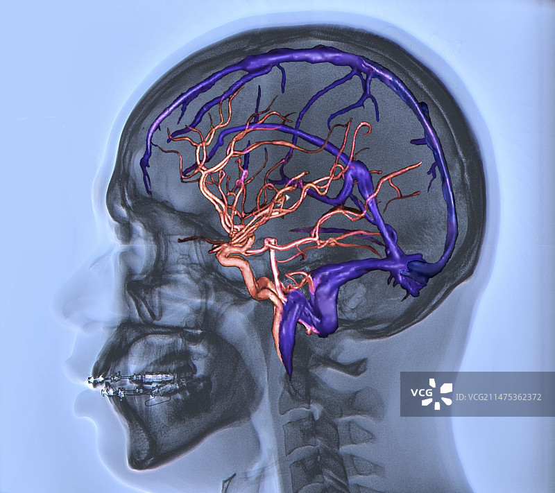 脑动脉和静脉窦3D CT血管造影图片素材