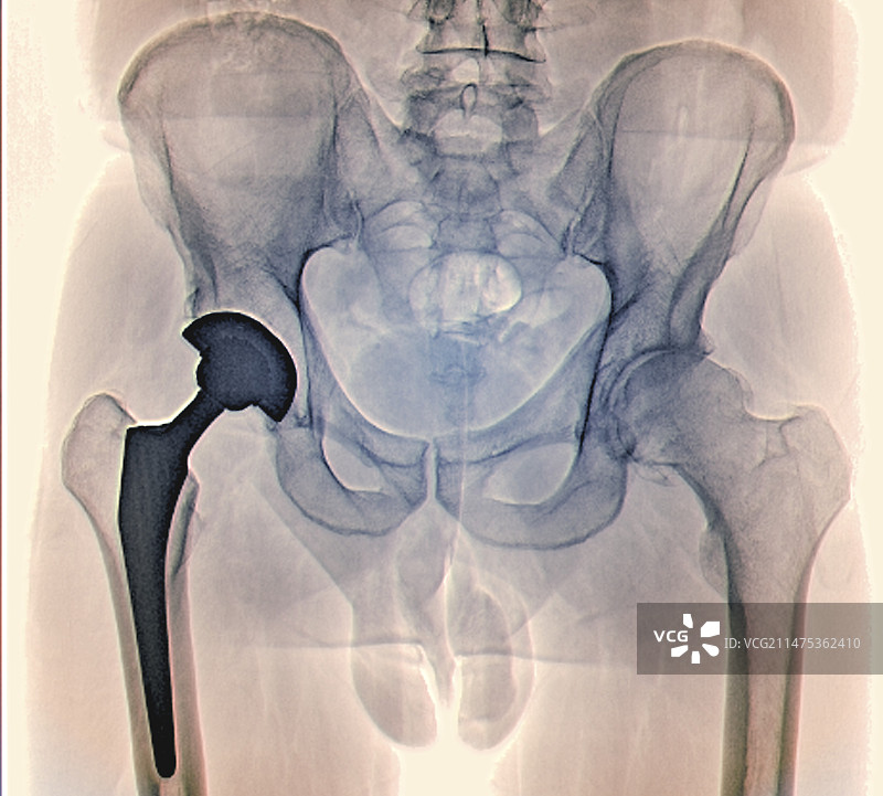 全髋关节置换X光片图片素材