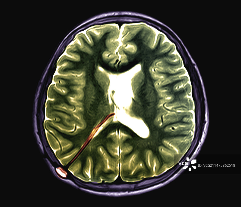 脑积水治疗核磁共振扫描图片素材