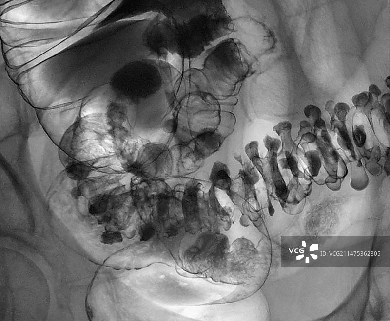 大肠憩室病X光片图片素材