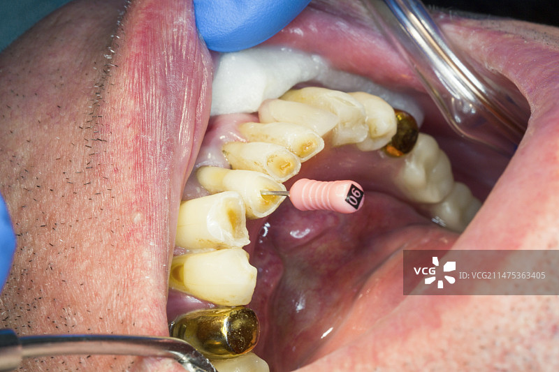 根管手术图片素材