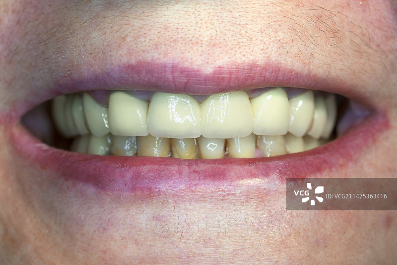 陶瓷牙冠图片素材