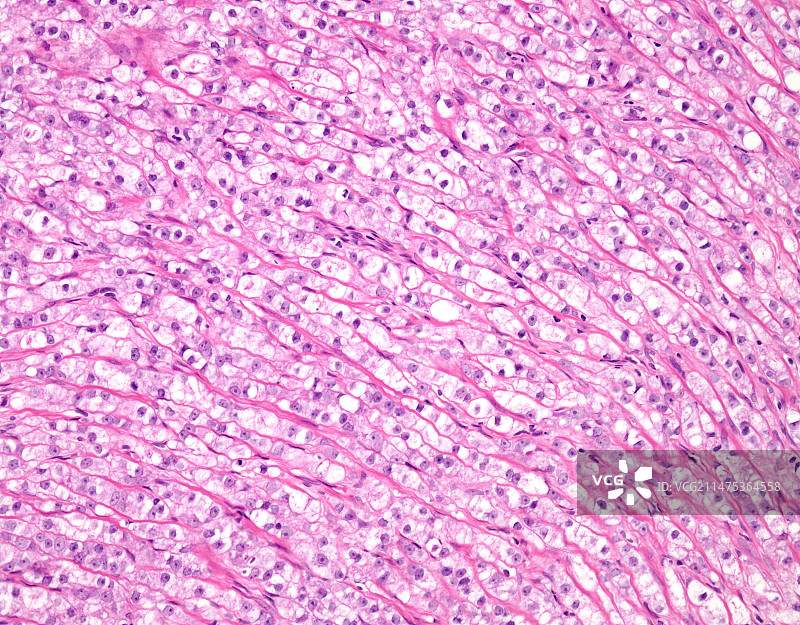 前列腺癌，光学显微照片图片素材