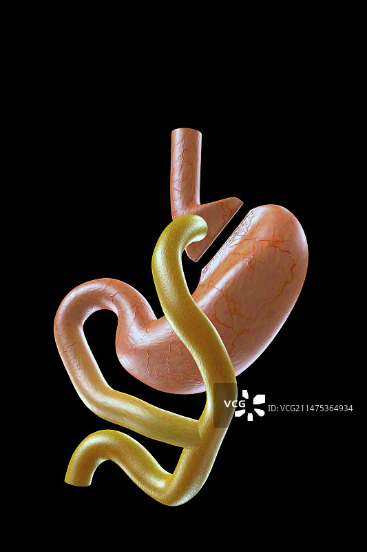 胃旁路手术示意图图片素材