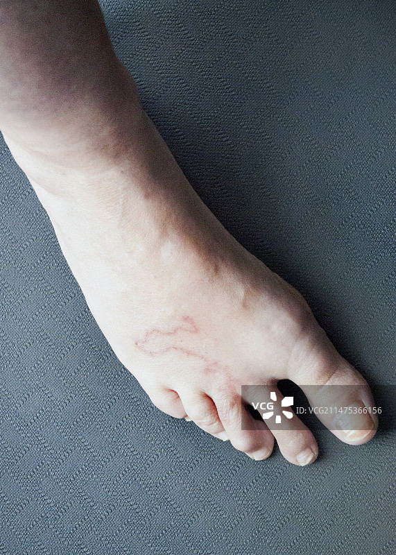 皮肤幼虫移行症感染图片素材