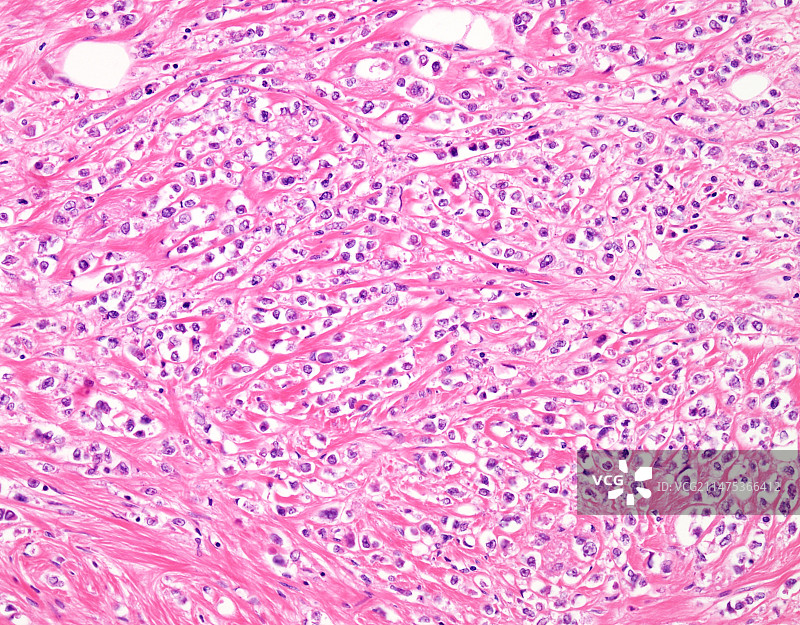 多形性小叶性乳腺癌光镜图片素材