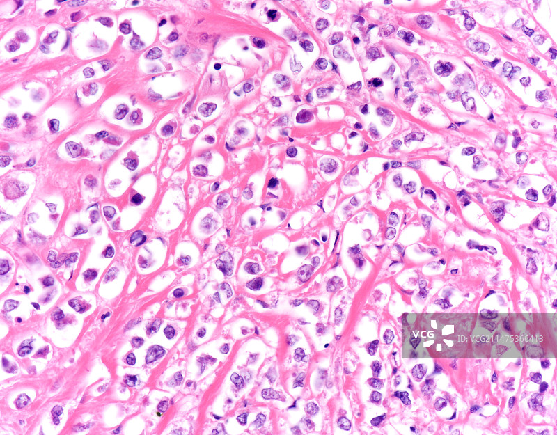 多形性小叶性乳腺癌光镜图片素材