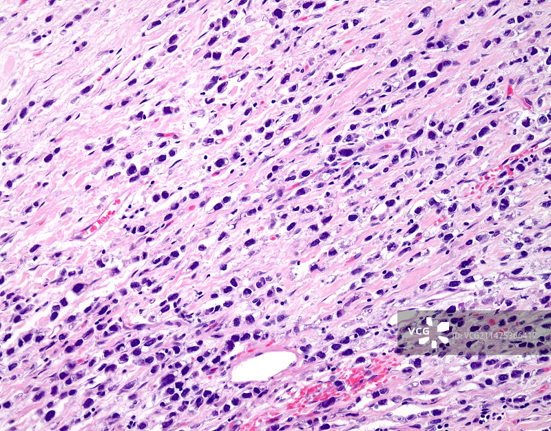 多形性小叶性乳腺癌光镜图片素材