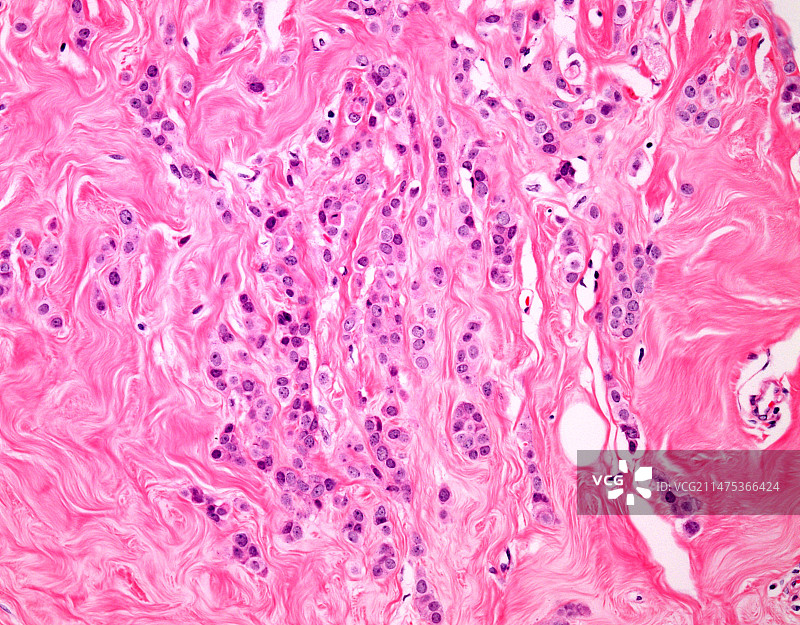 浸润性小叶乳腺癌显微照片图片素材