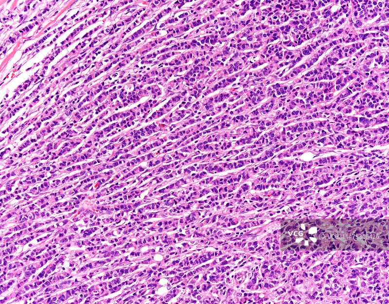 浸润性小叶乳腺癌显微照片图片素材