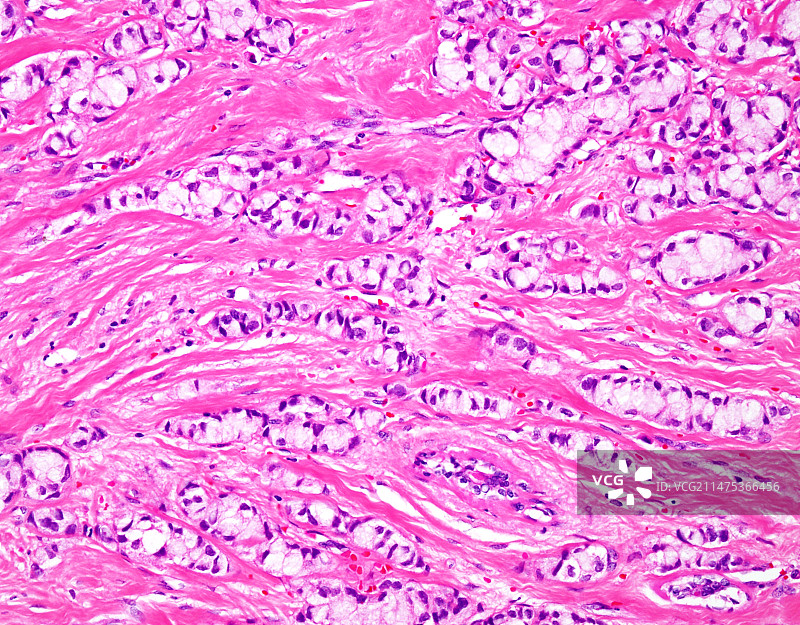 印戒细胞小叶乳腺癌显微照片图片素材